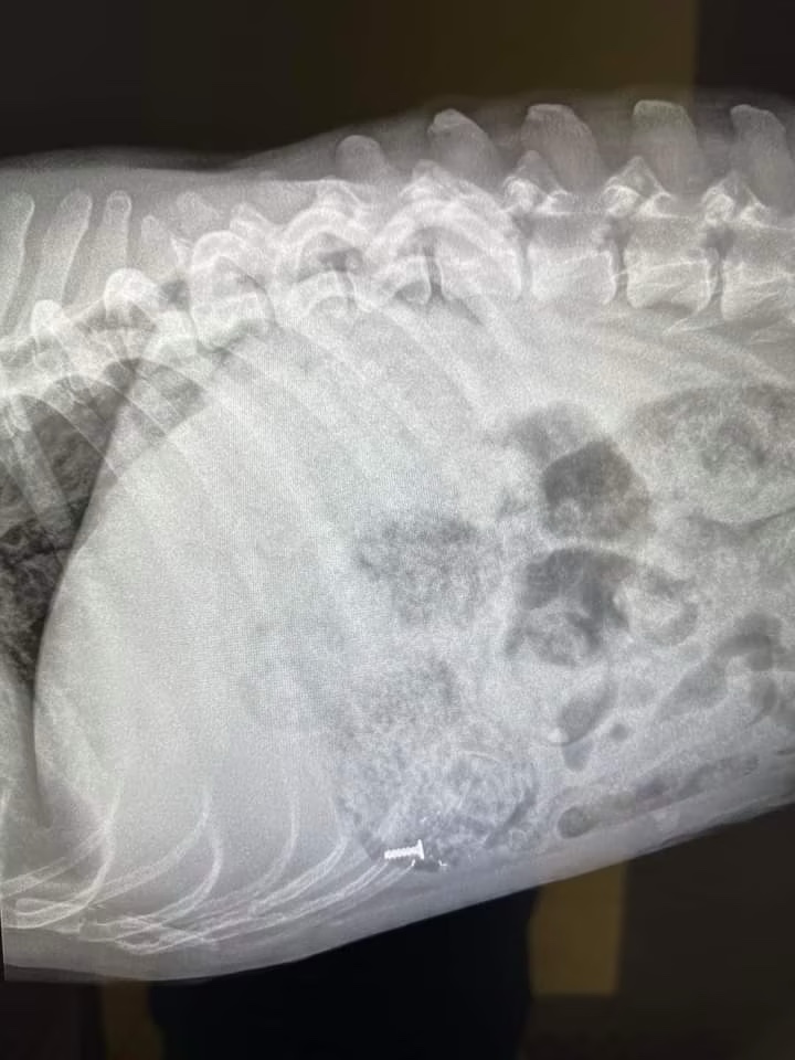 x-rays revealing a screw in stomach